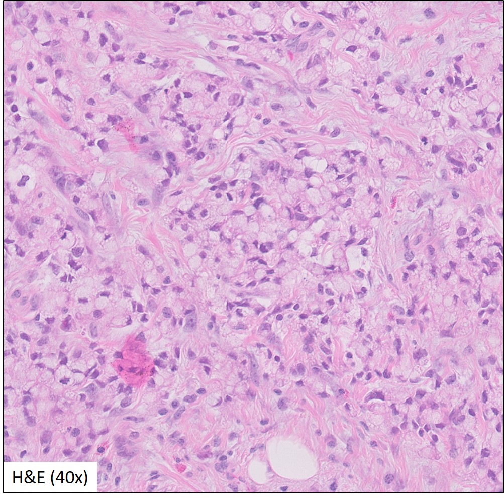 Microscopic image possibly detecting cancerous areas in human tissue