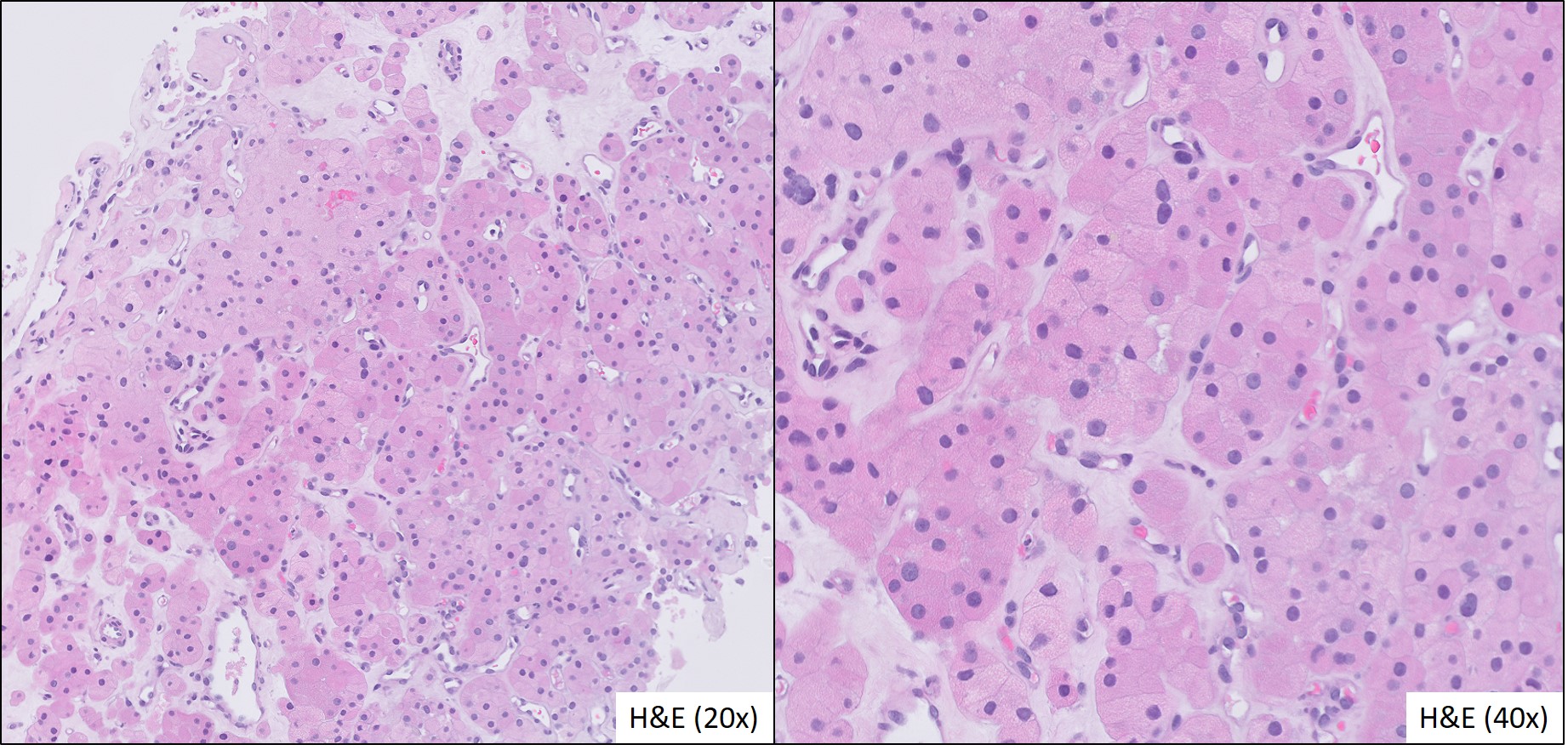 Microscopic image possibly detecting cancerous areas in human tissue