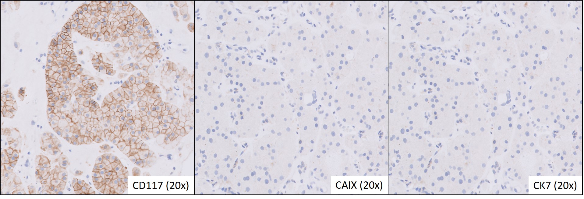 Microscopic image possibly detecting cancerous areas in human tissue