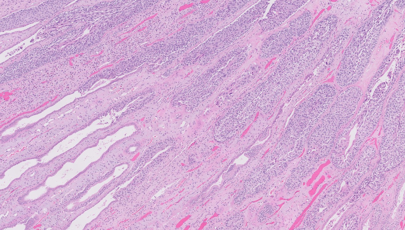 Microscopic image possibly detecting cancerous areas in human tissue