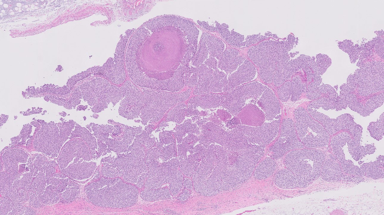 Microscopic image possibly detecting cancerous areas in human tissue