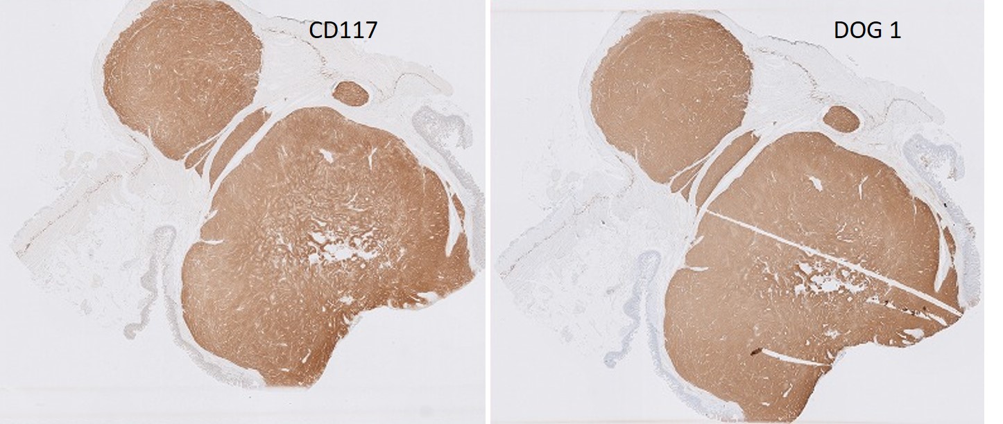 Microscopic image possibly detecting cancerous areas in human tissue