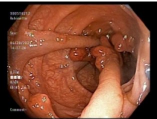 Small bowel endoscope image