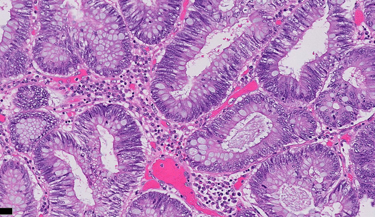 Microscopic image possibly detecting cancerous areas in human tissue