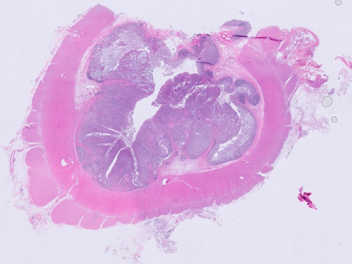 Microscopic image possibly detecting cancerous areas in human tissue