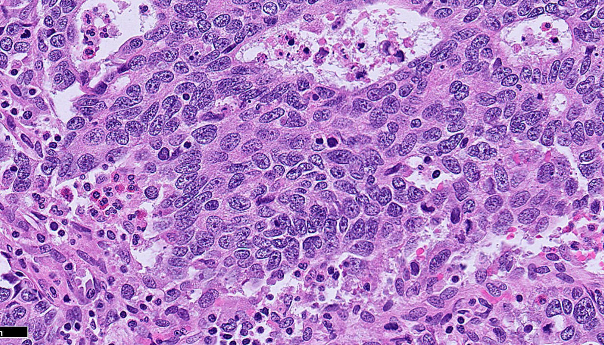 Microscopic image possibly detecting cancerous areas in human tissue