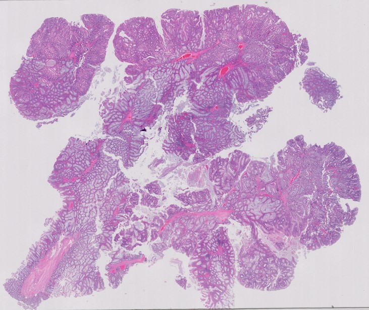 Microscopic image possibly detecting cancerous areas in human tissue