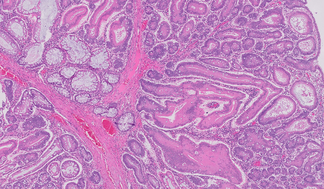 Microscopic image possibly detecting cancerous areas in human tissue