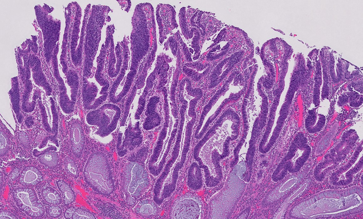 Microscopic image possibly detecting cancerous areas in human tissue