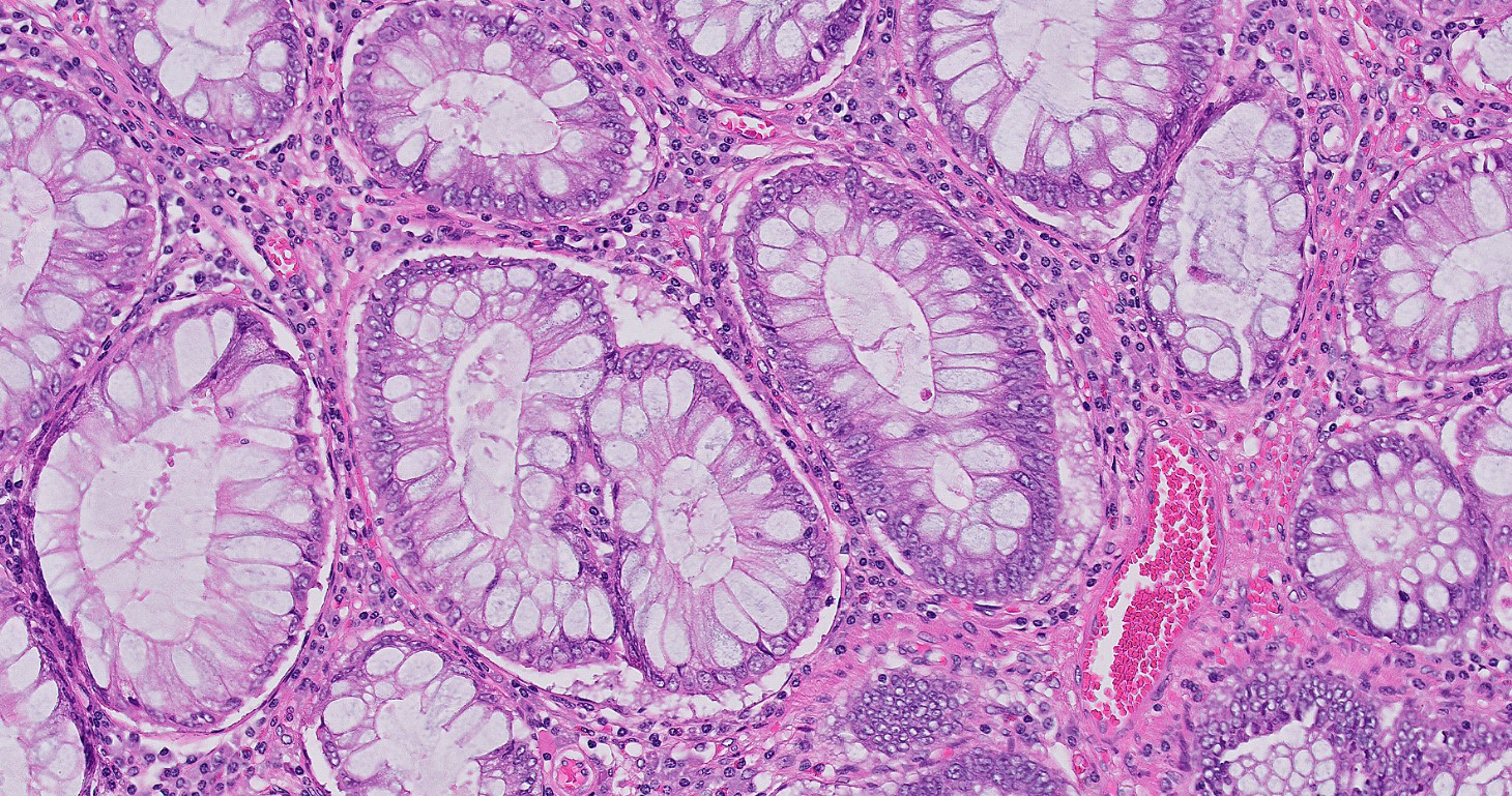 Microscopic image possibly detecting cancerous areas in human tissue