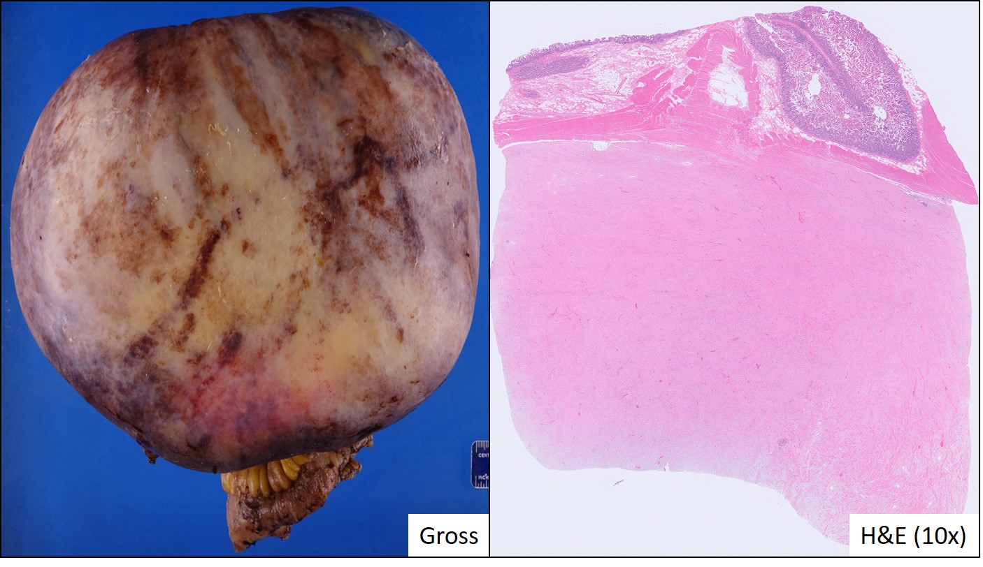 Gross and microscopic image possibly detecting cancerous areas in human tissue