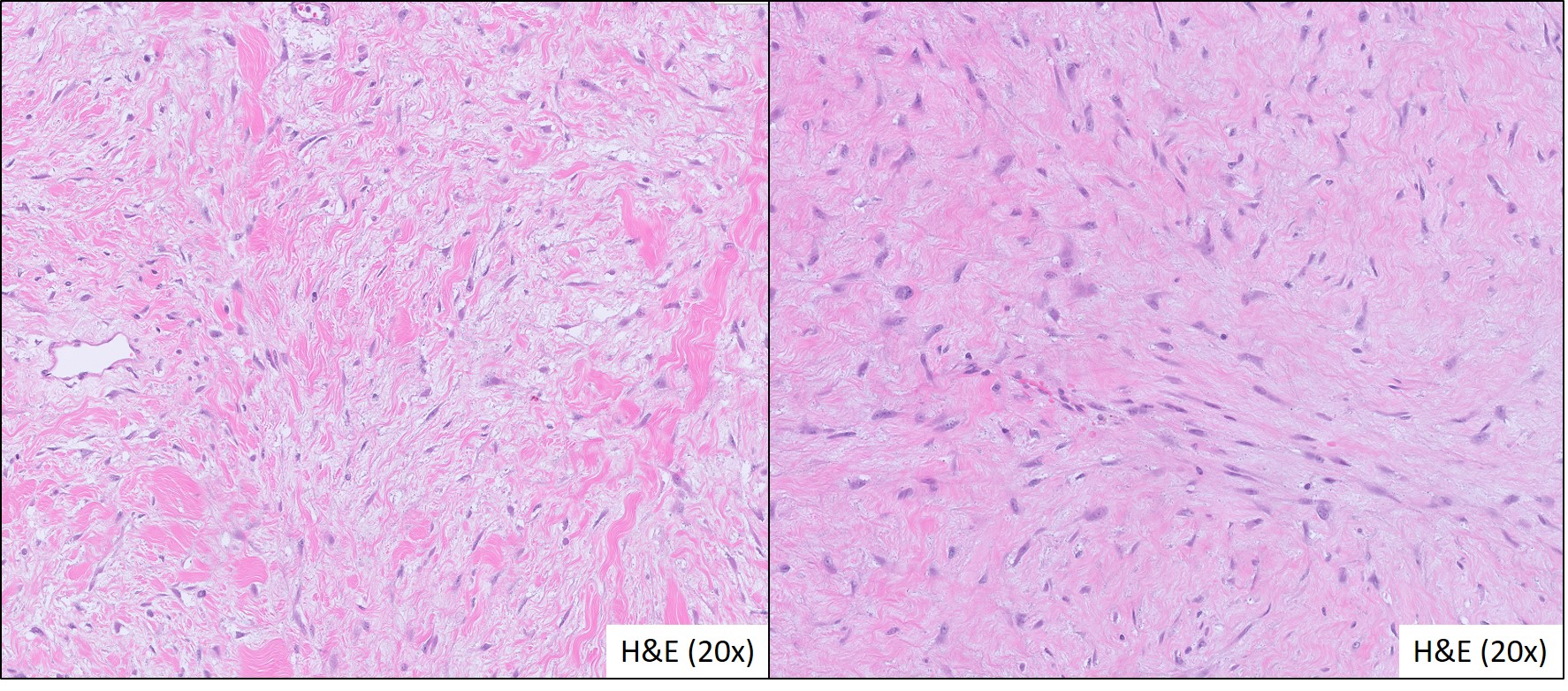 Microscopic image possibly detecting cancerous areas in human tissue