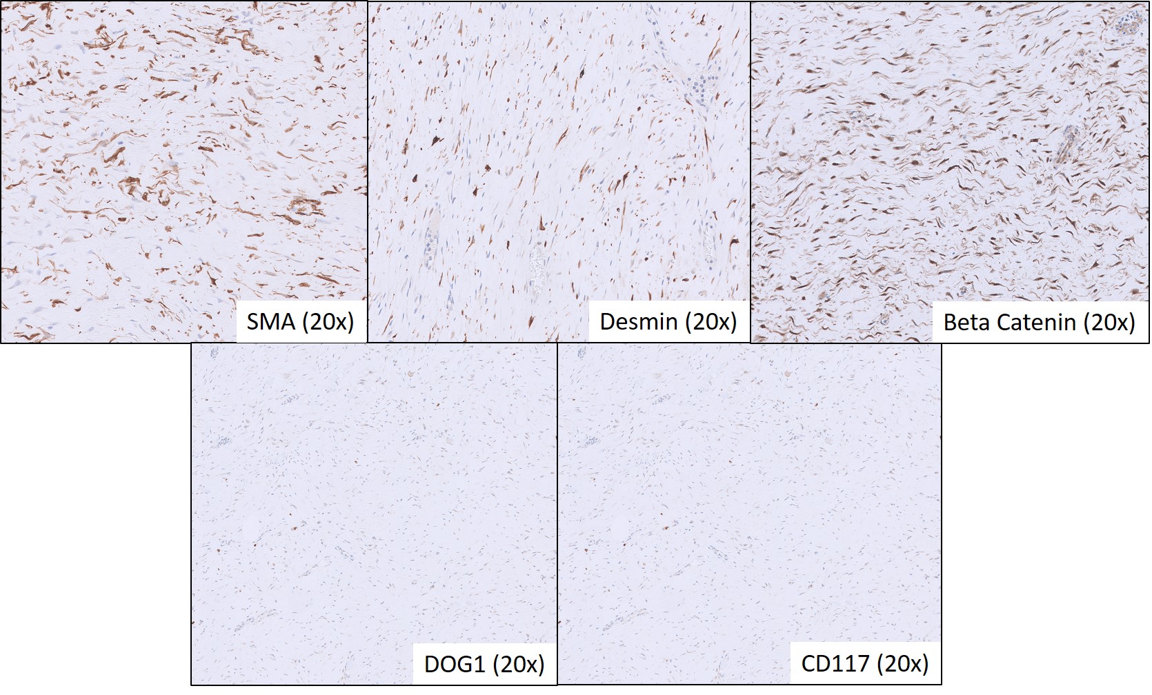 Microscopic image possibly detecting cancerous areas in human tissue