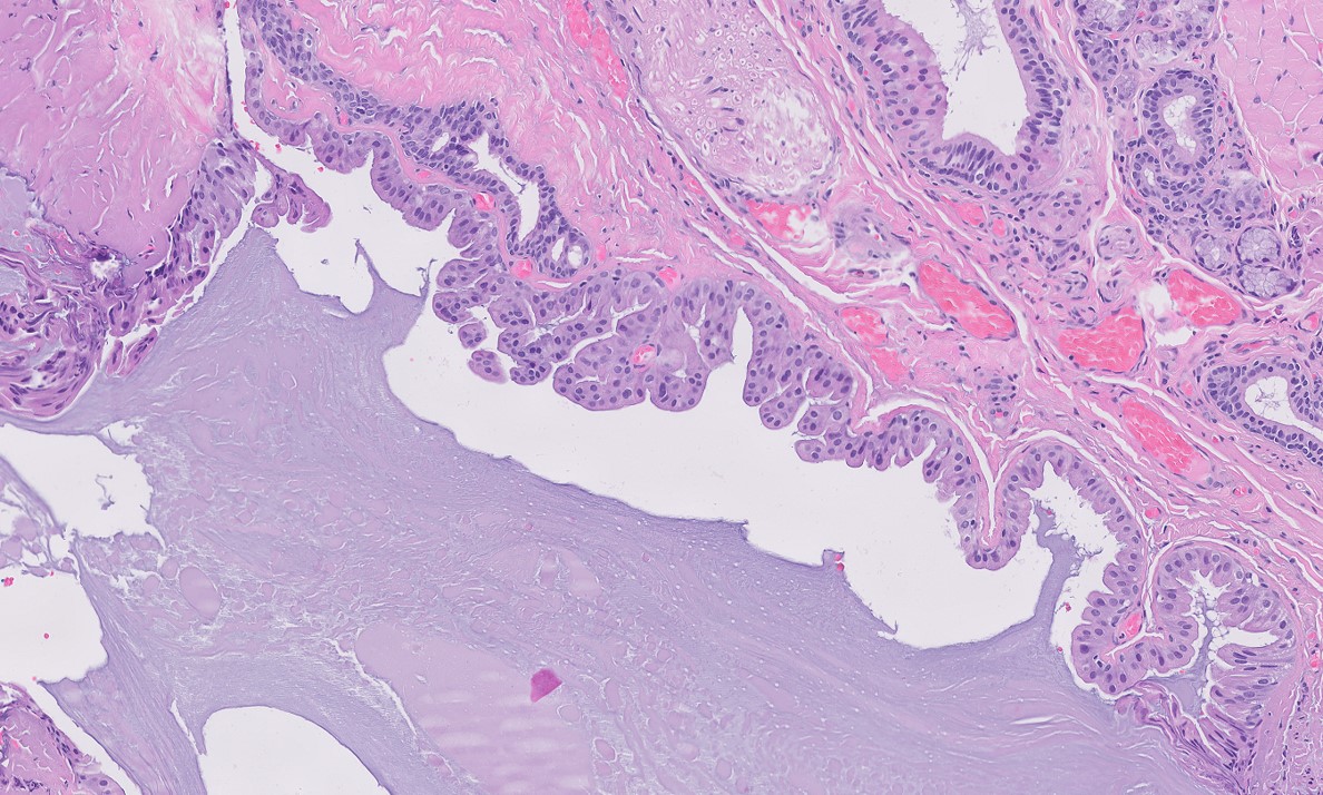 Microscopic image possibly detecting cancerous areas in human tissue