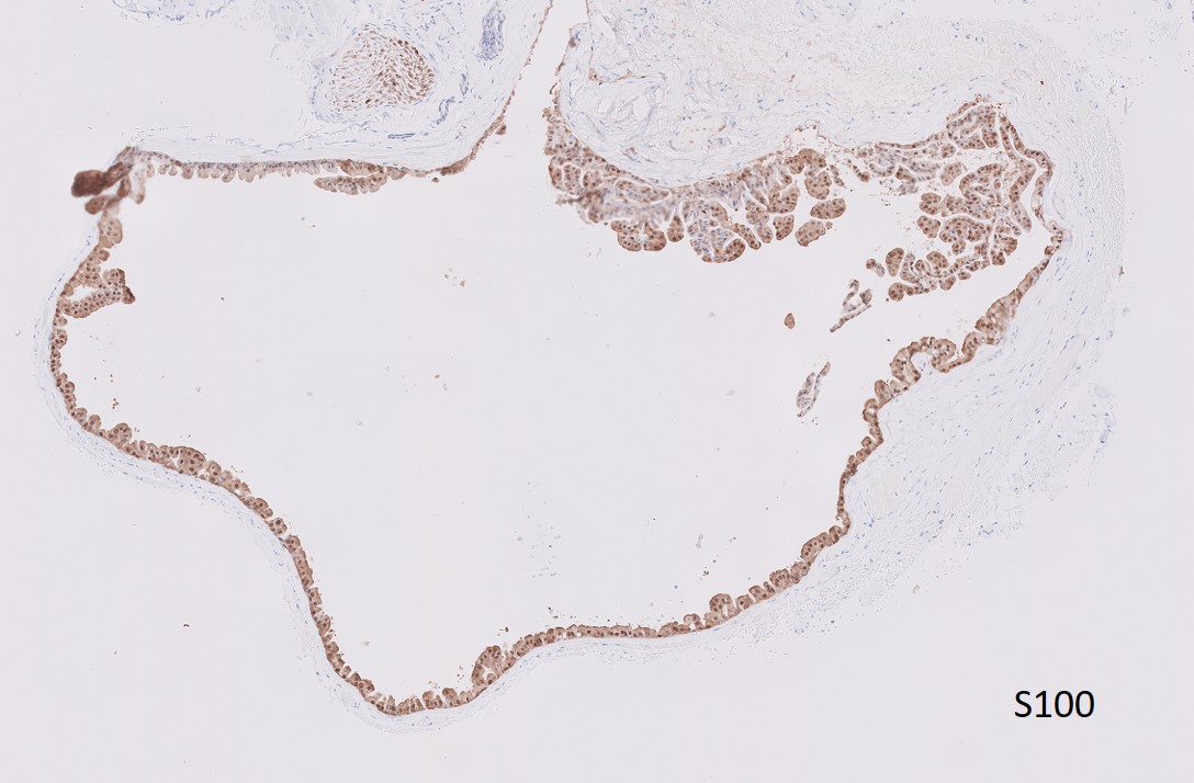 Microscopic image possibly detecting cancerous areas in human tissue