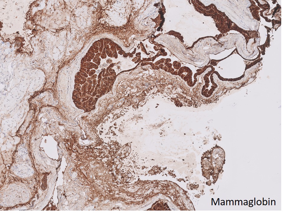 Table depicting positive IHC markers