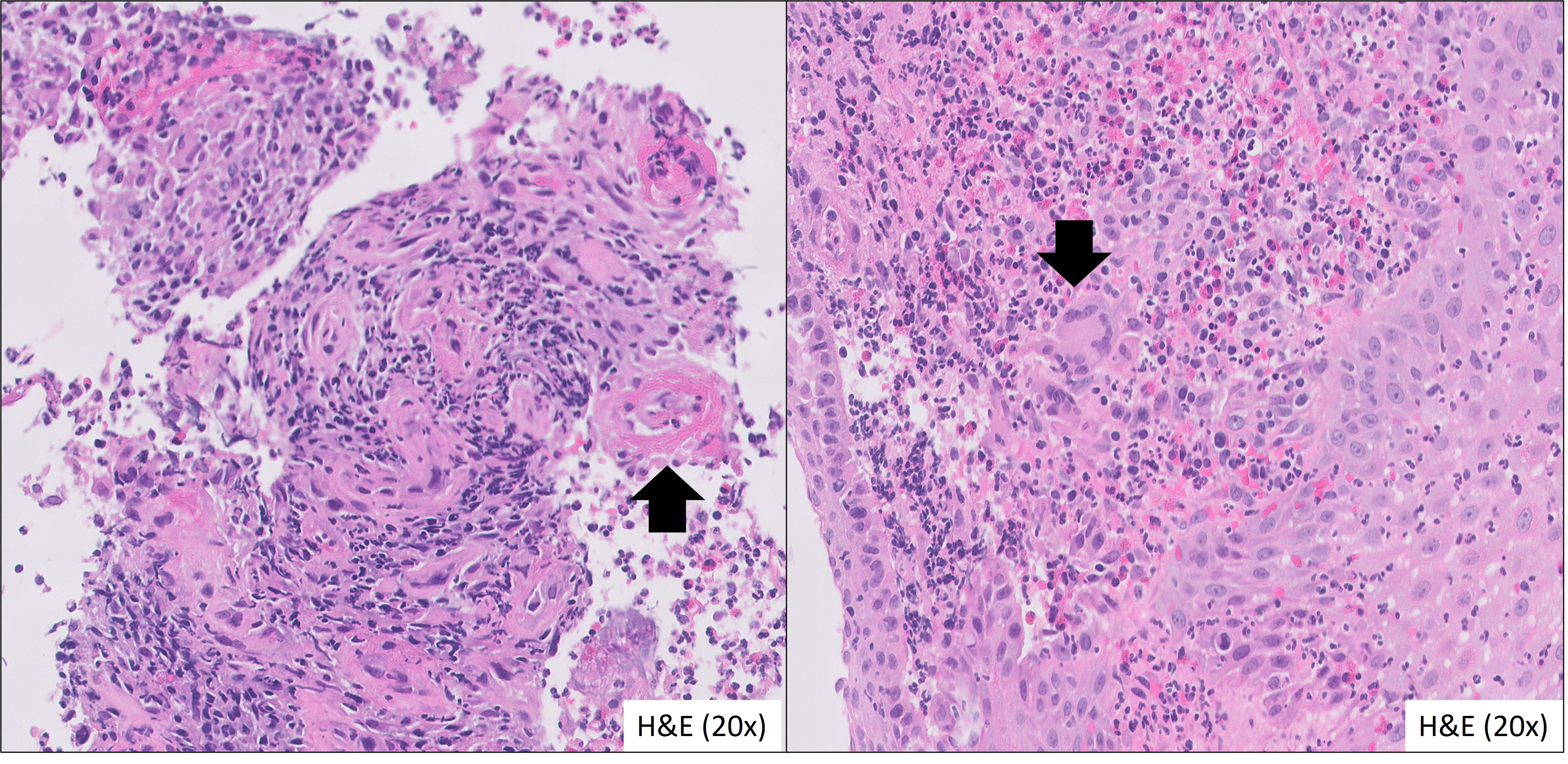 Microscopic image possibly detecting cancerous areas in human tissue