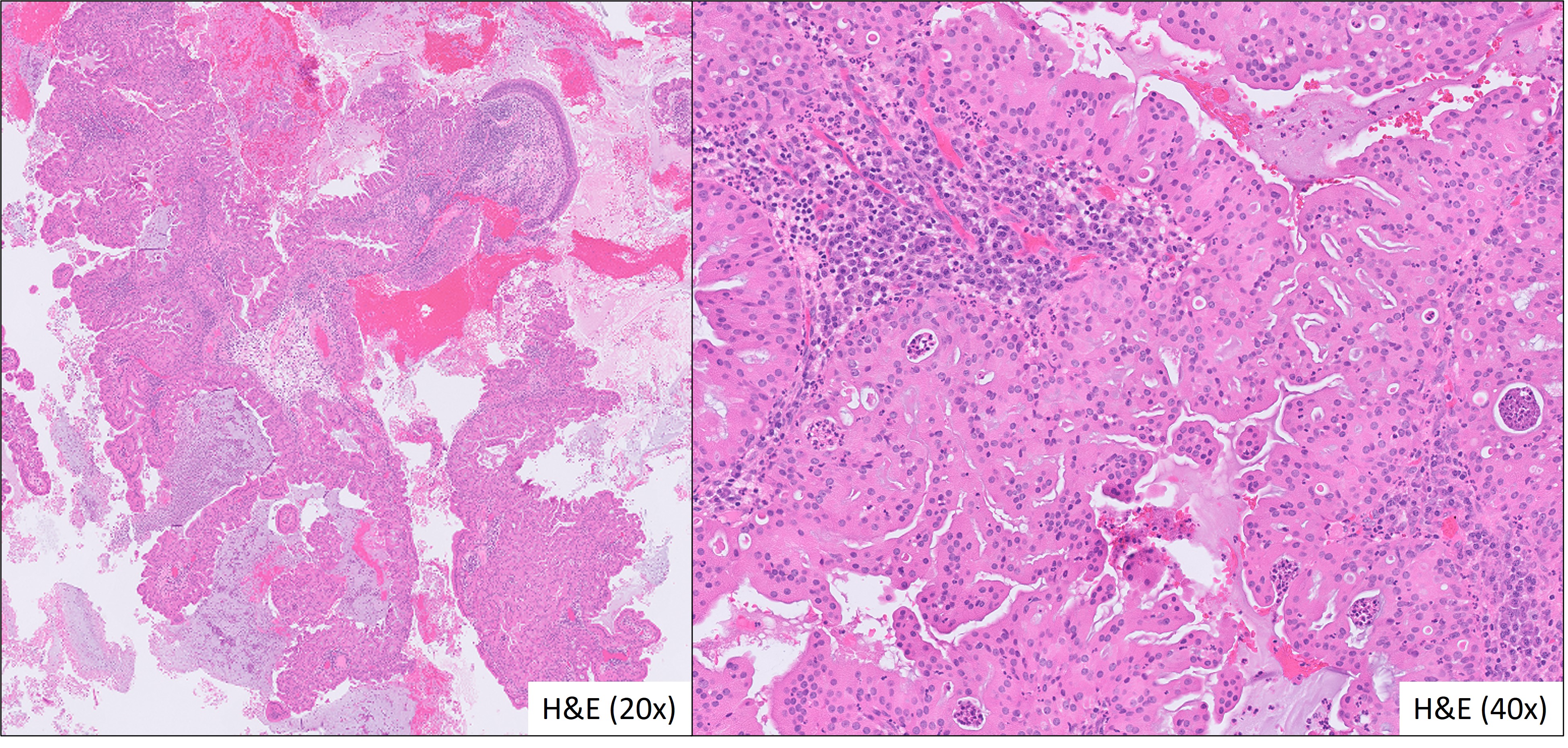 Microscopic image possibly detecting cancerous areas in human tissue