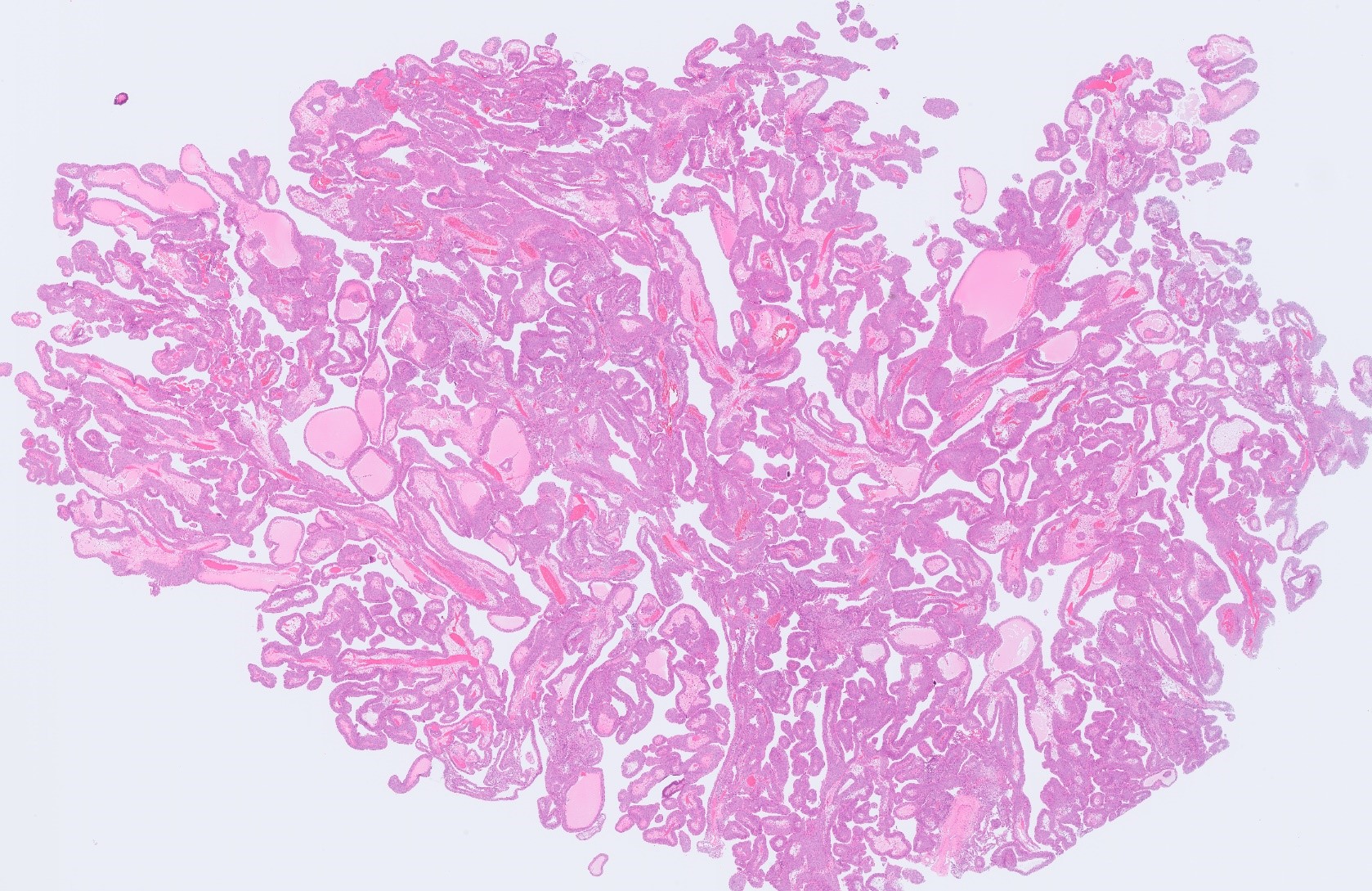 Microscopic image possibly detecting cancerous areas in human tissue