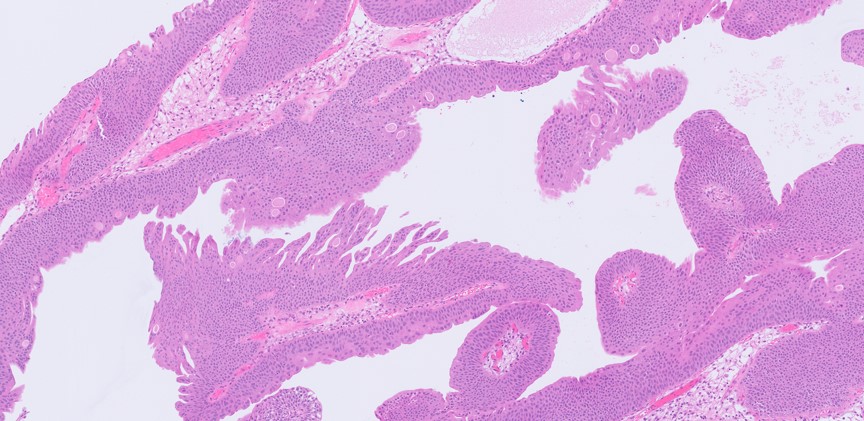 Microscopic image possibly detecting cancerous areas in human tissue