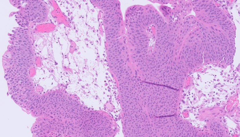 Microscopic image possibly detecting cancerous areas in human tissue