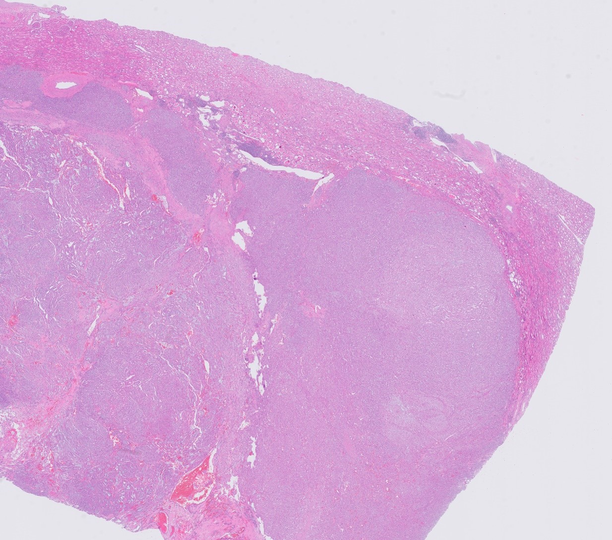 Microscopic image possibly detecting cancerous areas in human tissue