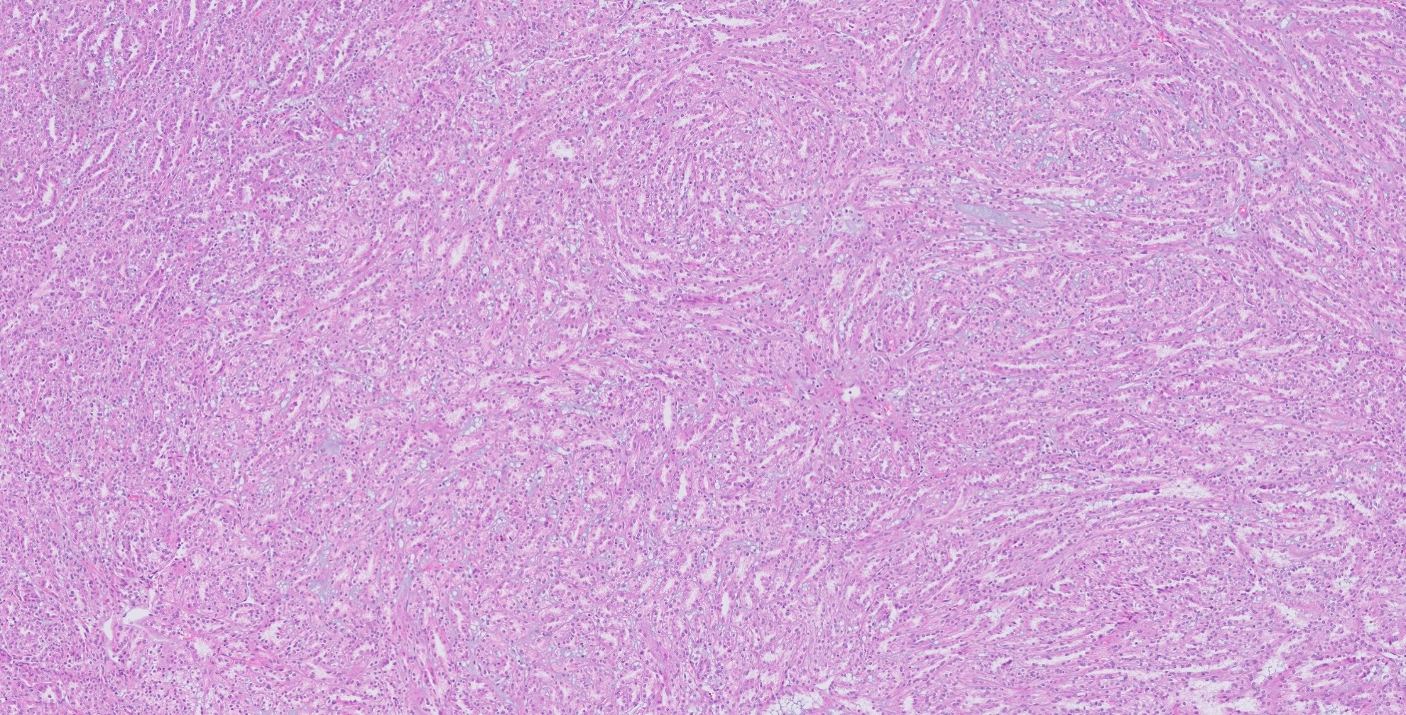 Microscopic image possibly detecting cancerous areas in human tissue