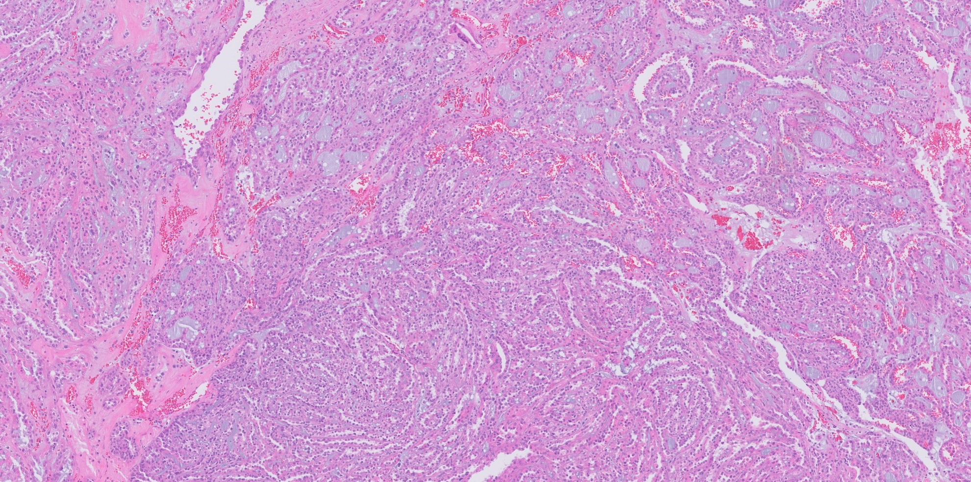 Microscopic image possibly detecting cancerous areas in human tissue