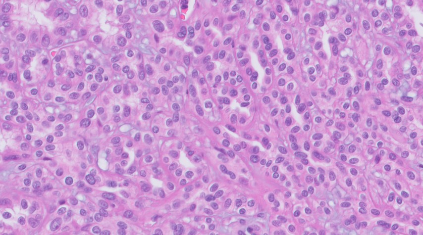 Microscopic image possibly detecting cancerous areas in human tissue