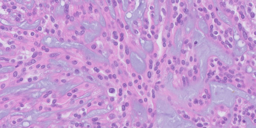 Microscopic image possibly detecting cancerous areas in human tissue