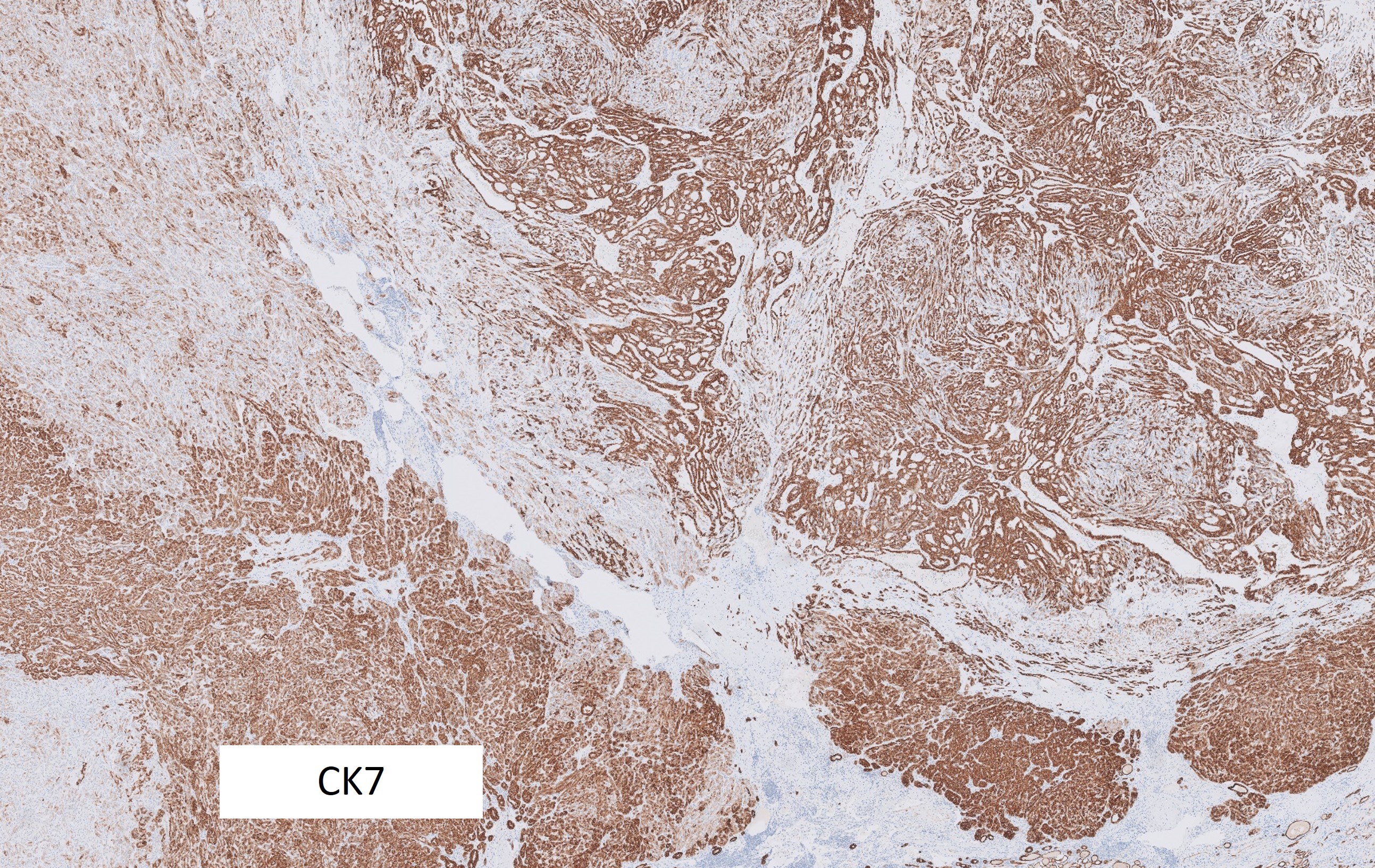 Microscopic image possibly detecting cancerous areas in human tissue