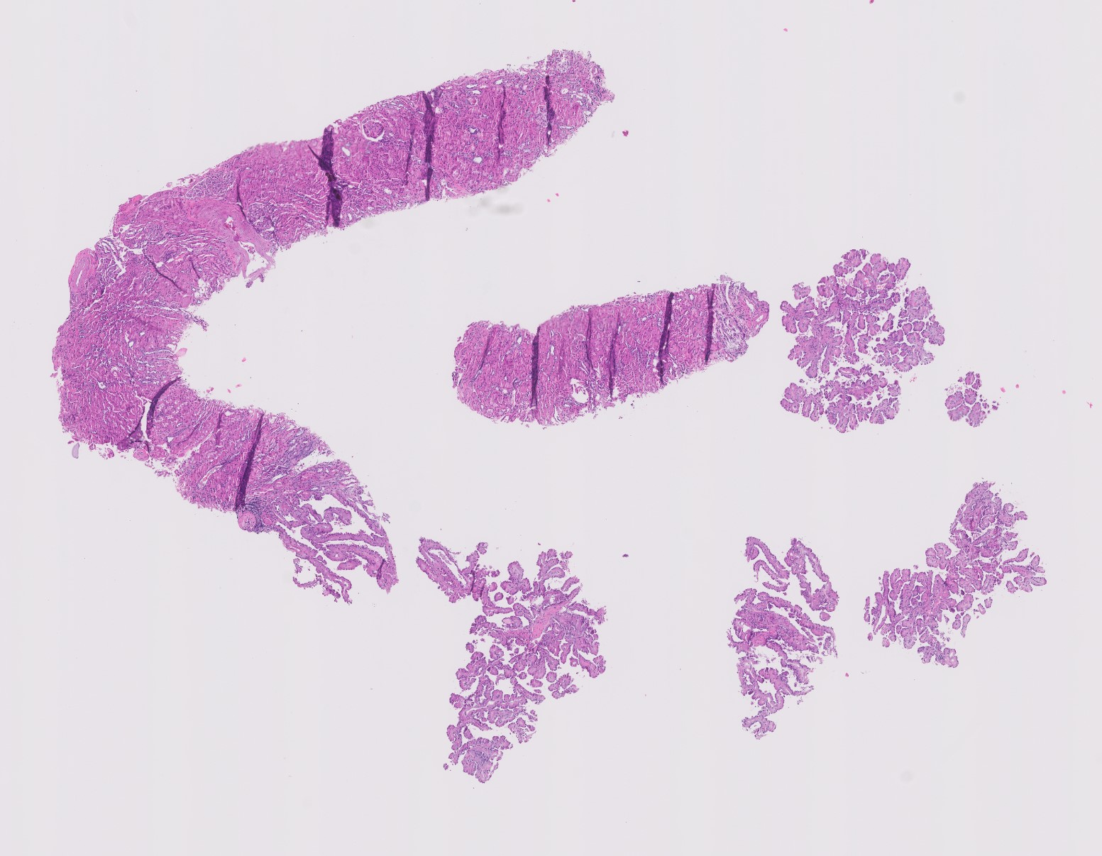 Microscopic image possibly detecting cancerous areas in human tissue