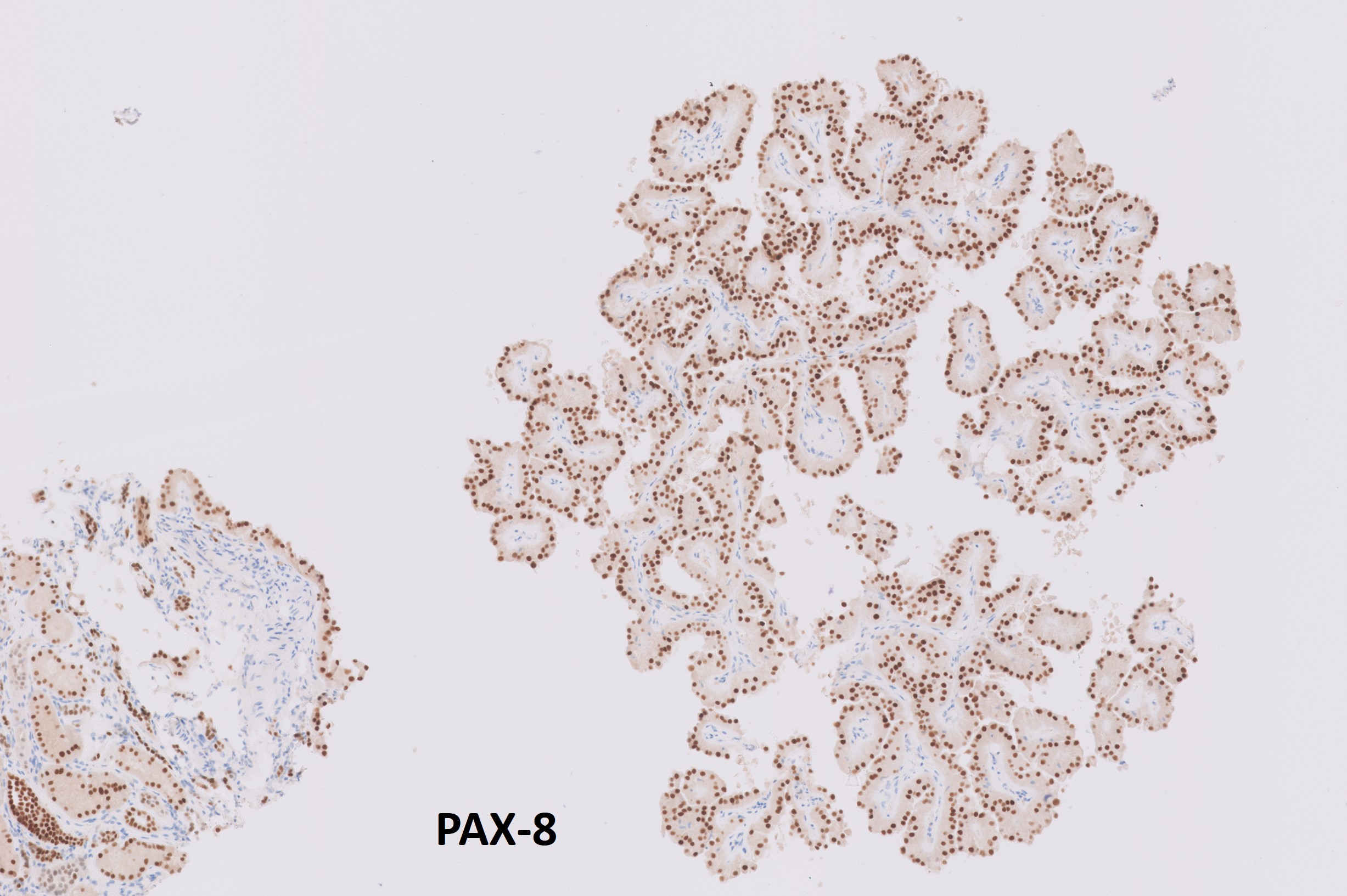 Microscopic image possibly detecting cancerous areas in human tissue