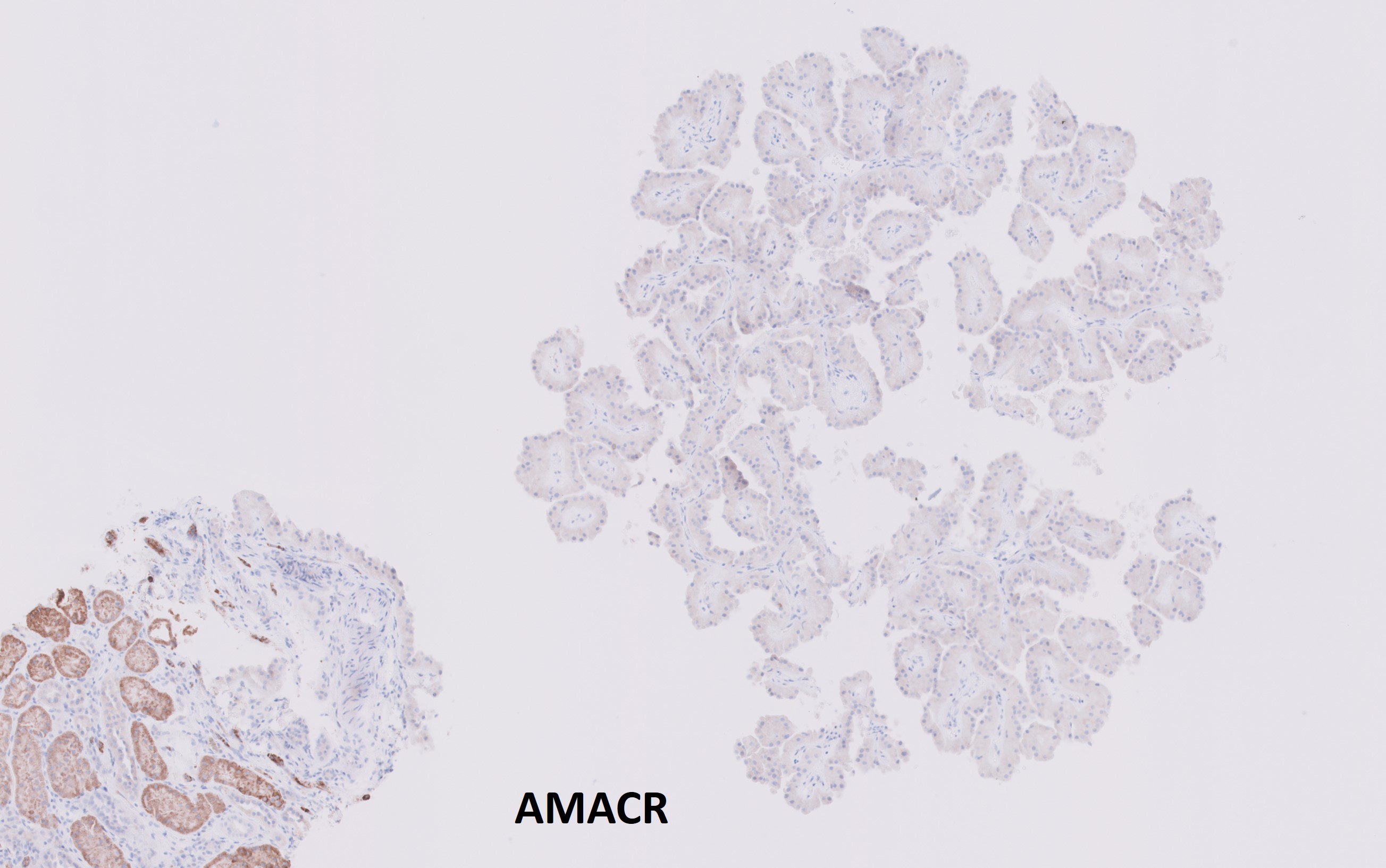 Microscopic image possibly detecting cancerous areas in human tissue