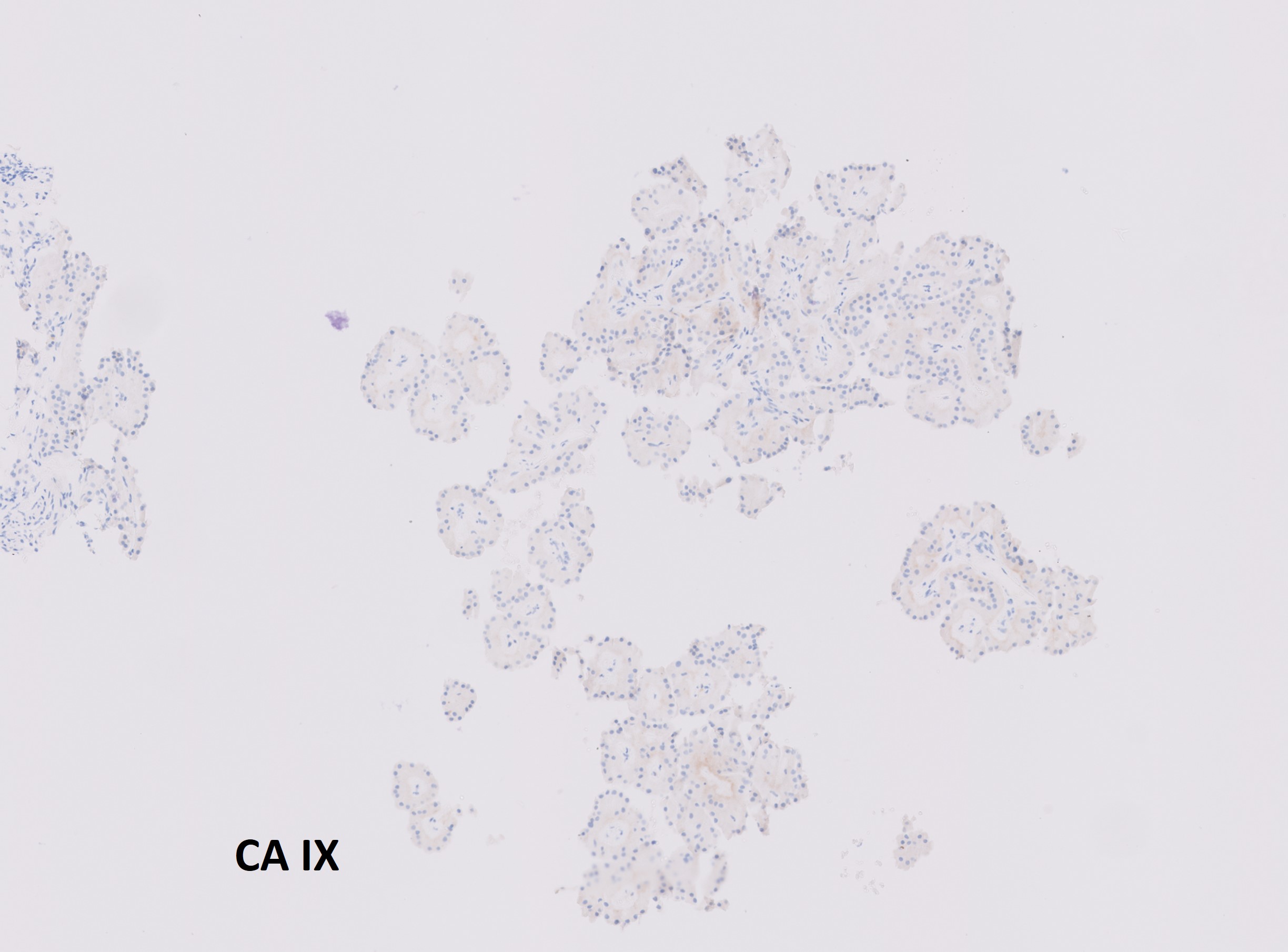 Microscopic image possibly detecting cancerous areas in human tissue