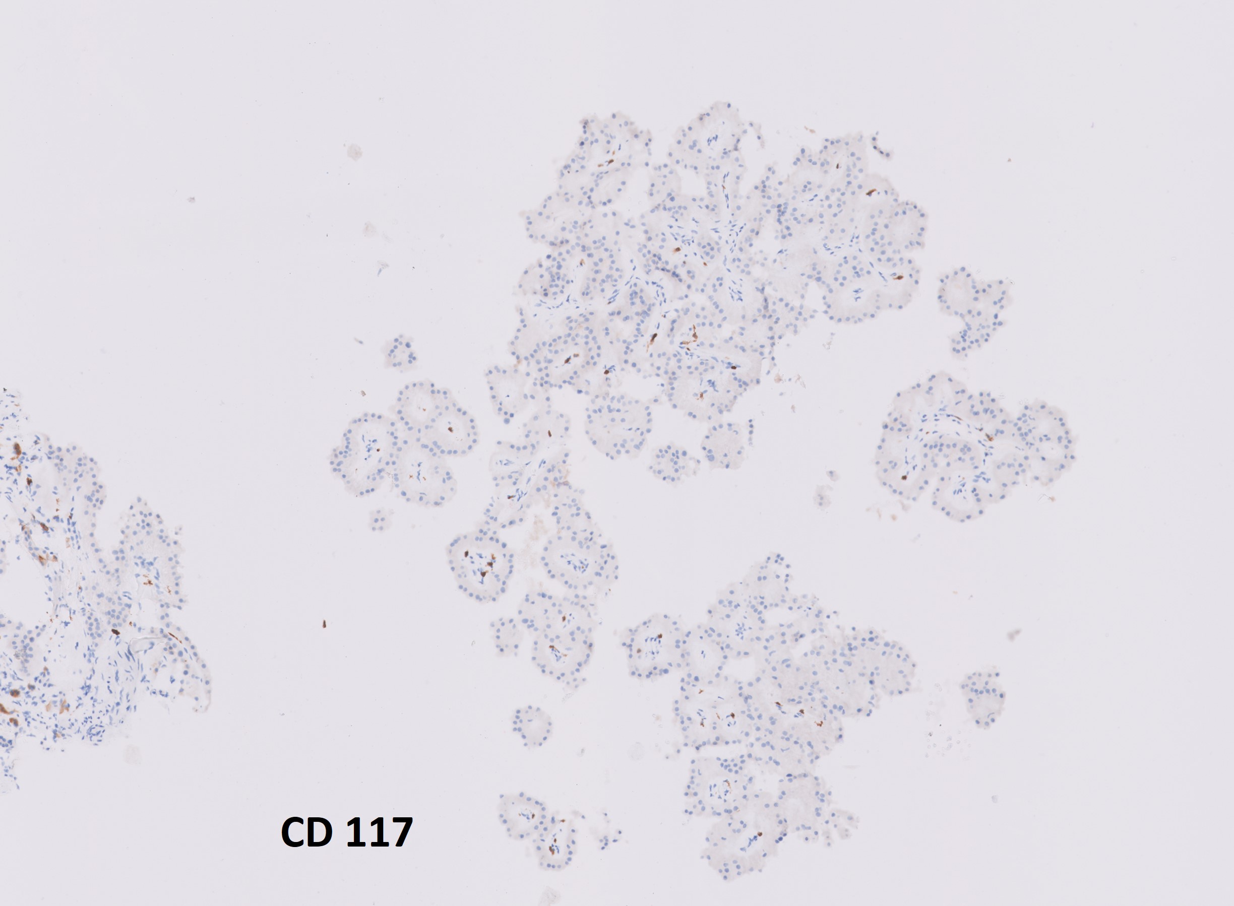 Microscopic image possibly detecting cancerous areas in human tissue