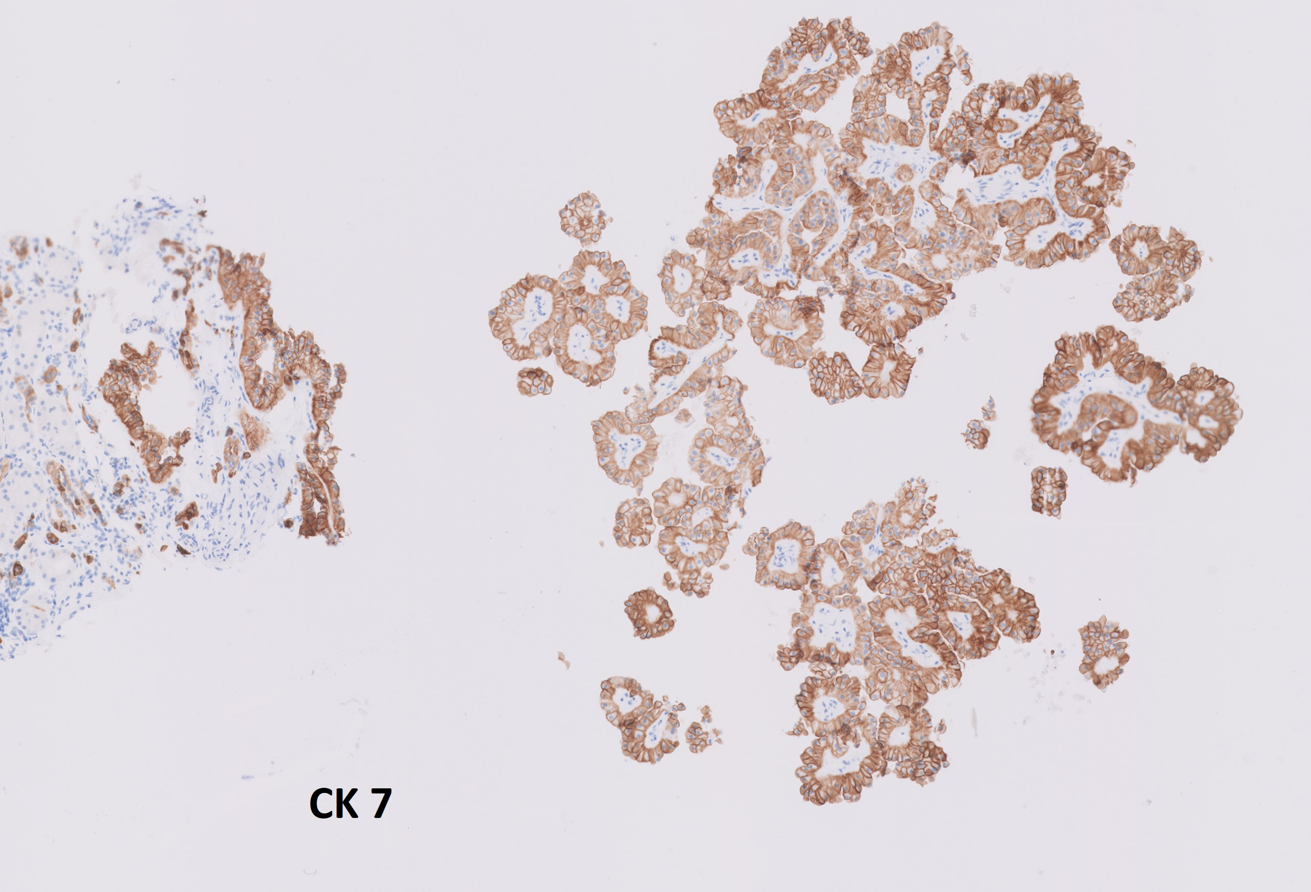 Microscopic image possibly detecting cancerous areas in human tissue