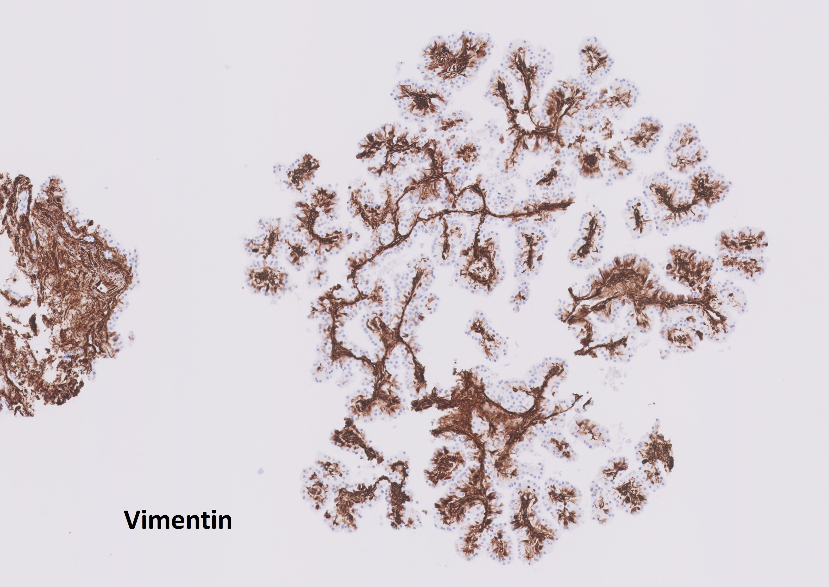 Microscopic image possibly detecting cancerous areas in human tissue