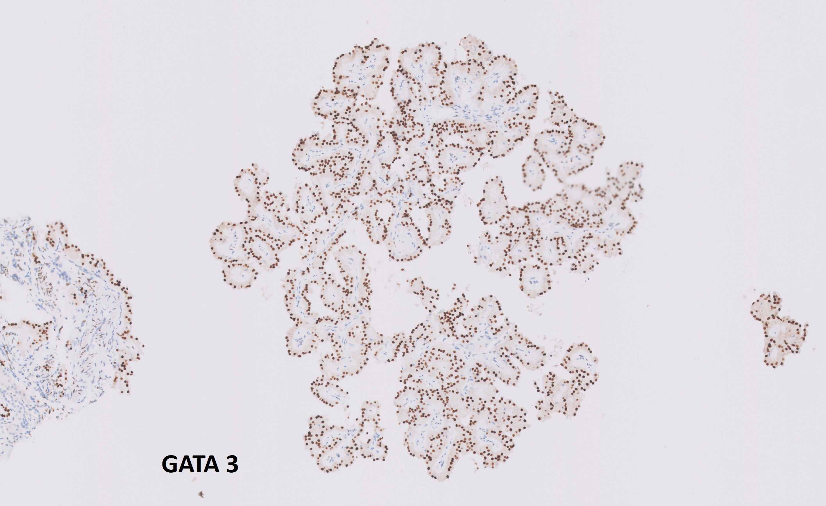 Microscopic image possibly detecting cancerous areas in human tissue