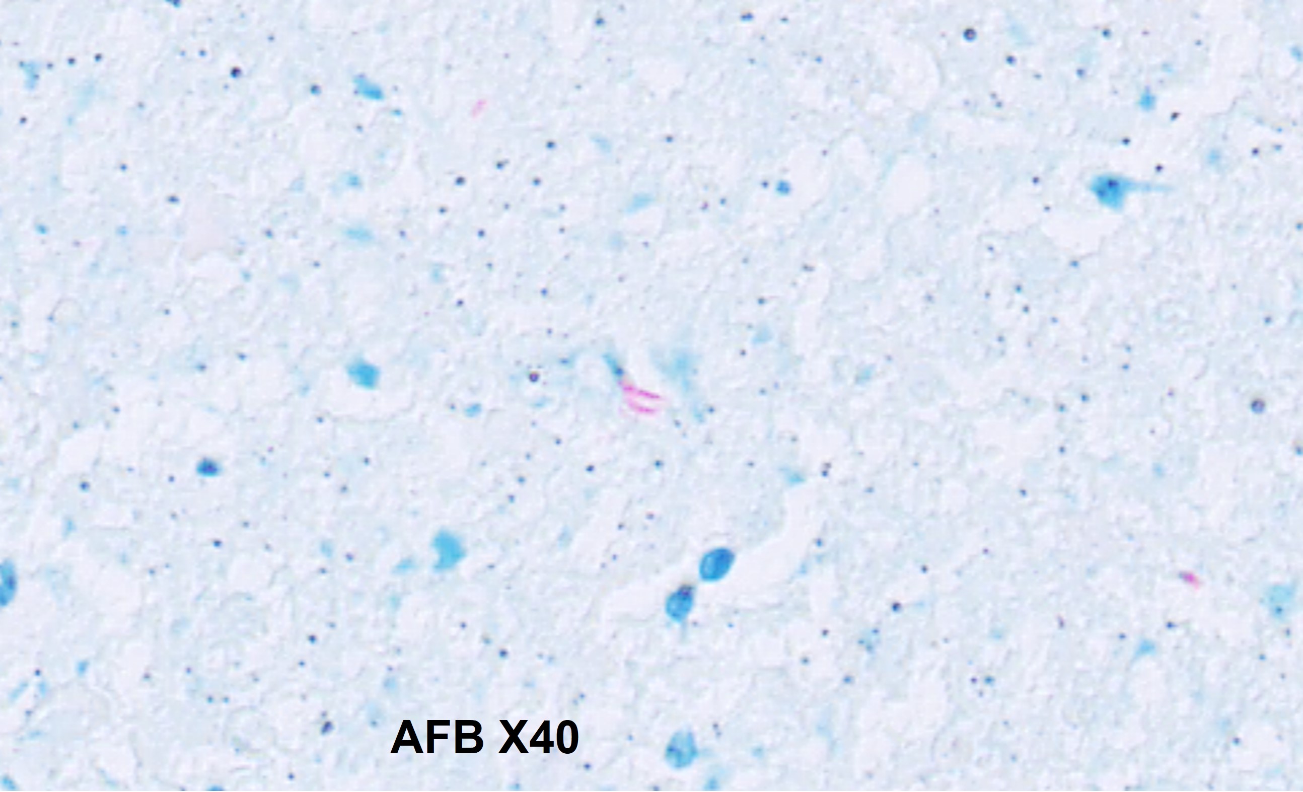 Microscopic image possibly detecting cancerous areas in human tissue