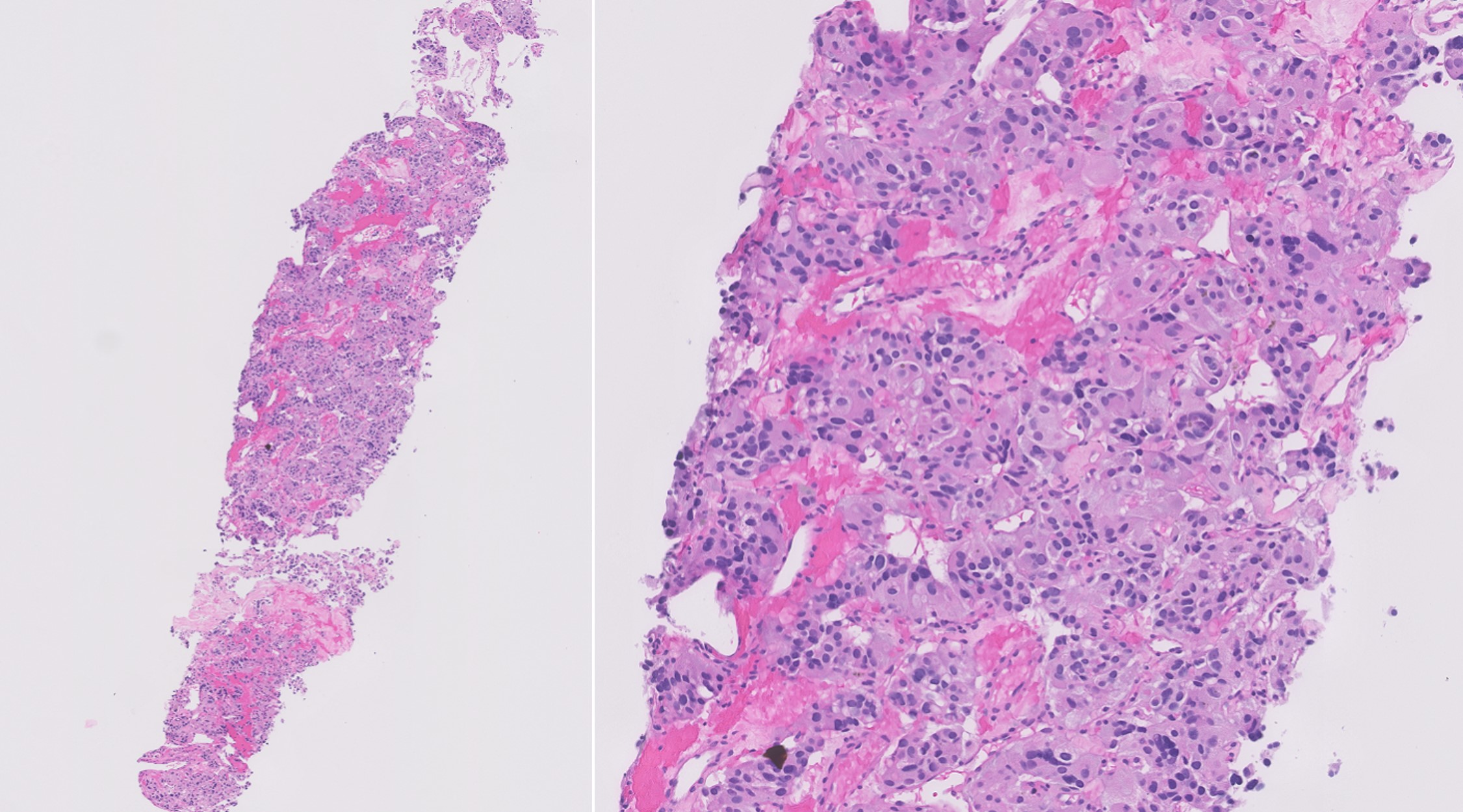 Microscopic image possibly detecting cancerous areas in human tissue