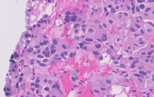 Microscopic image possibly detecting cancerous areas in human tissue