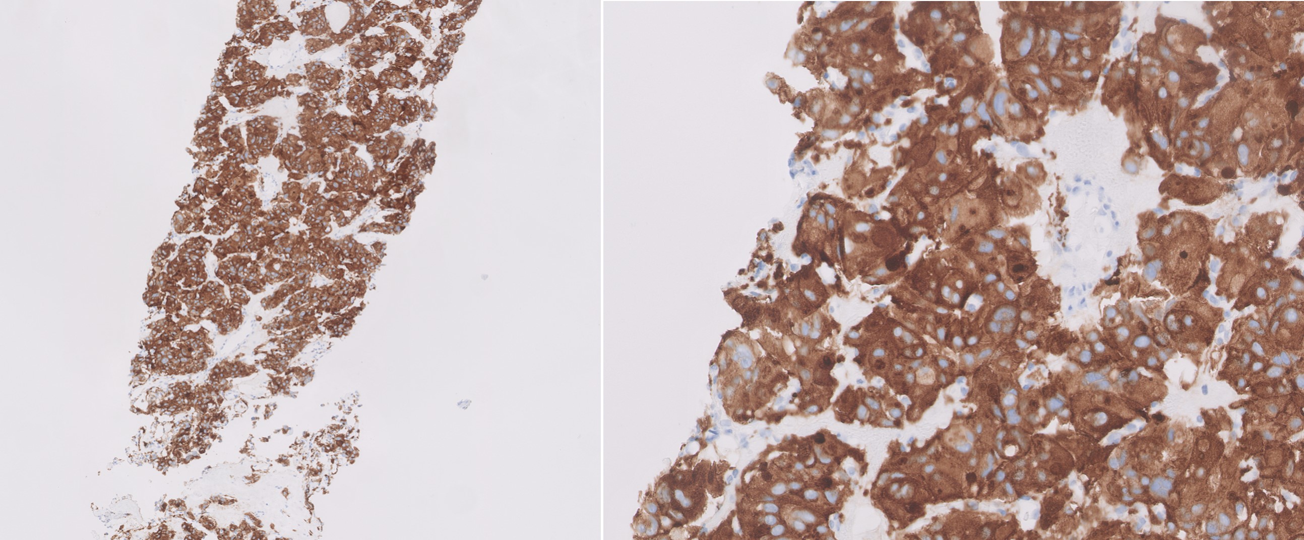 Microscopic image possibly detecting cancerous areas in human tissue