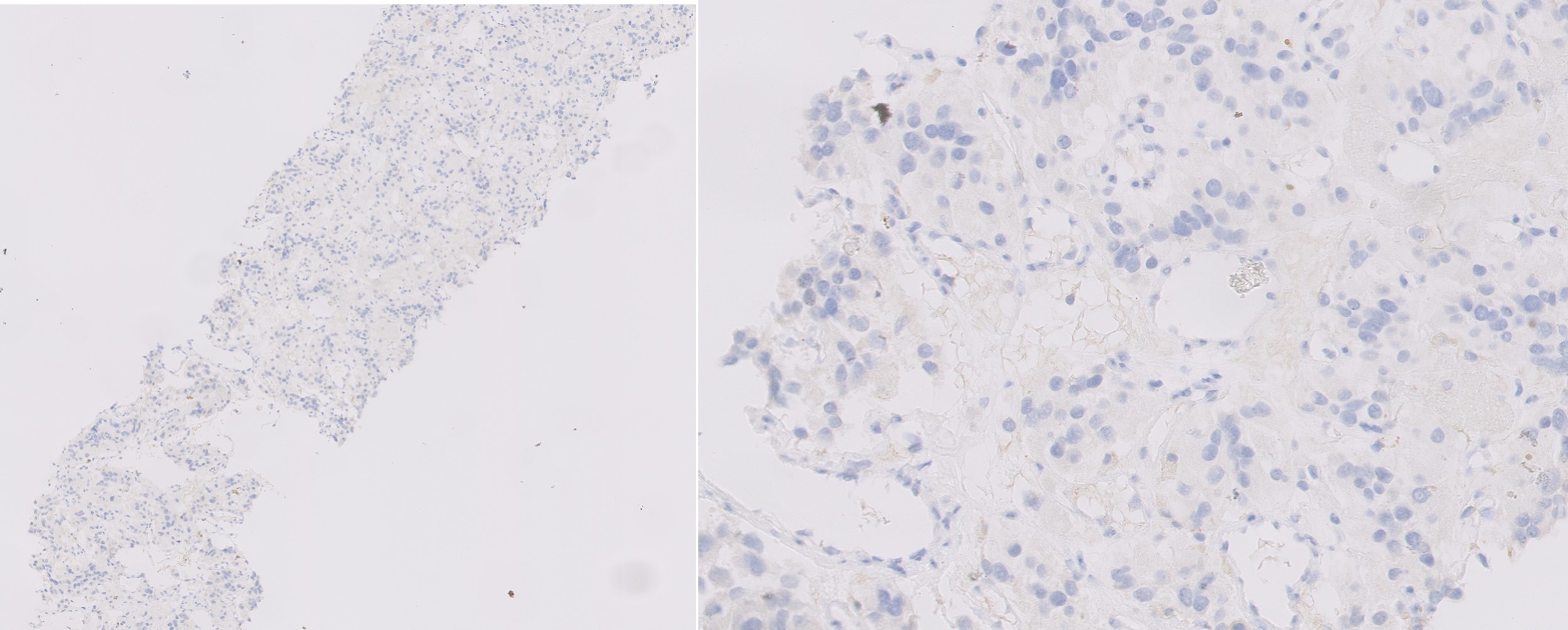 Microscopic image possibly detecting cancerous areas in human tissue