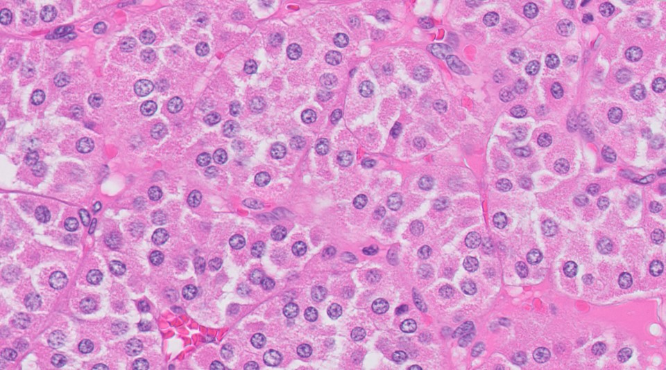 Microscopic image possibly detecting cancerous areas in human tissue