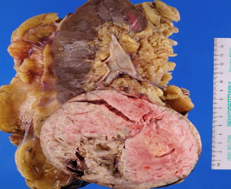 Gross image of kidney