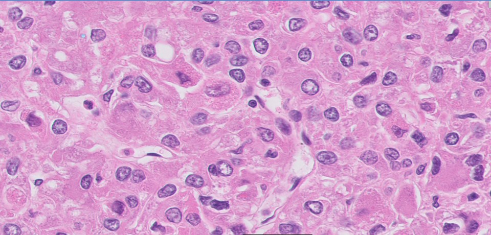 Microscopic image possibly detecting cancerous areas in human tissue