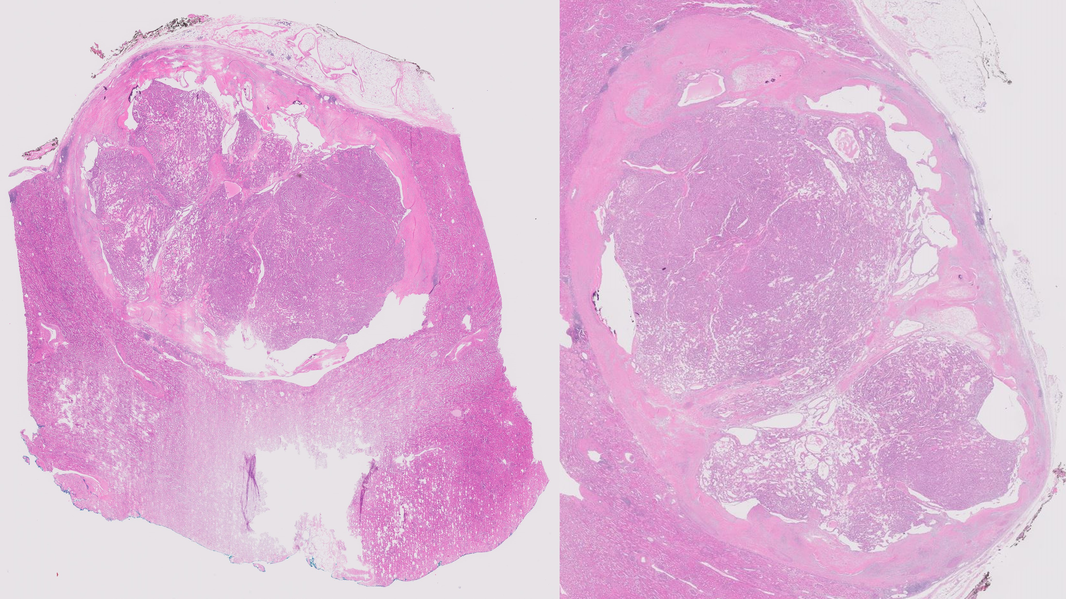 Microscopic image possibly detecting cancerous areas in human tissue