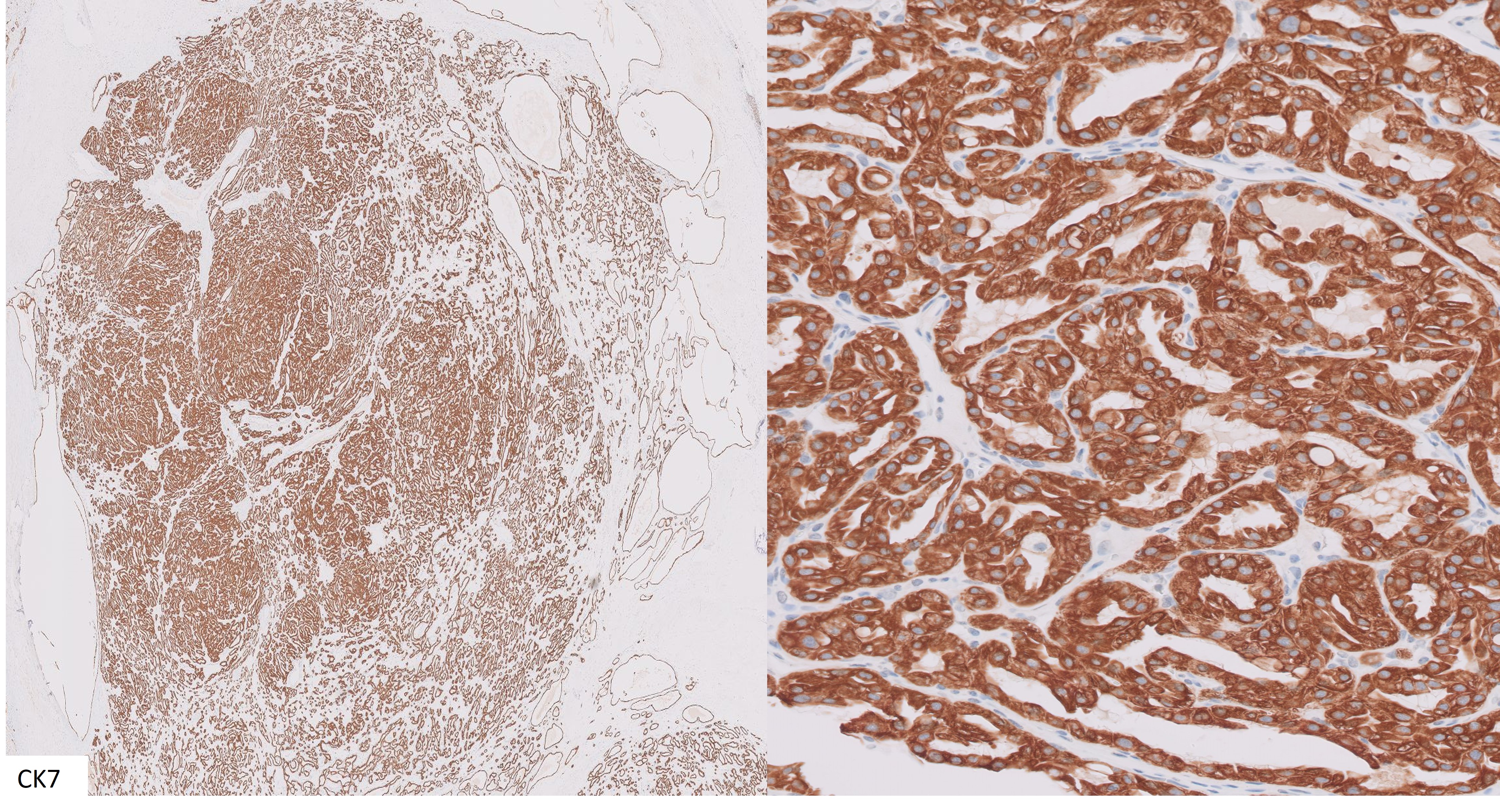 Microscopic image possibly detecting cancerous areas in human tissue