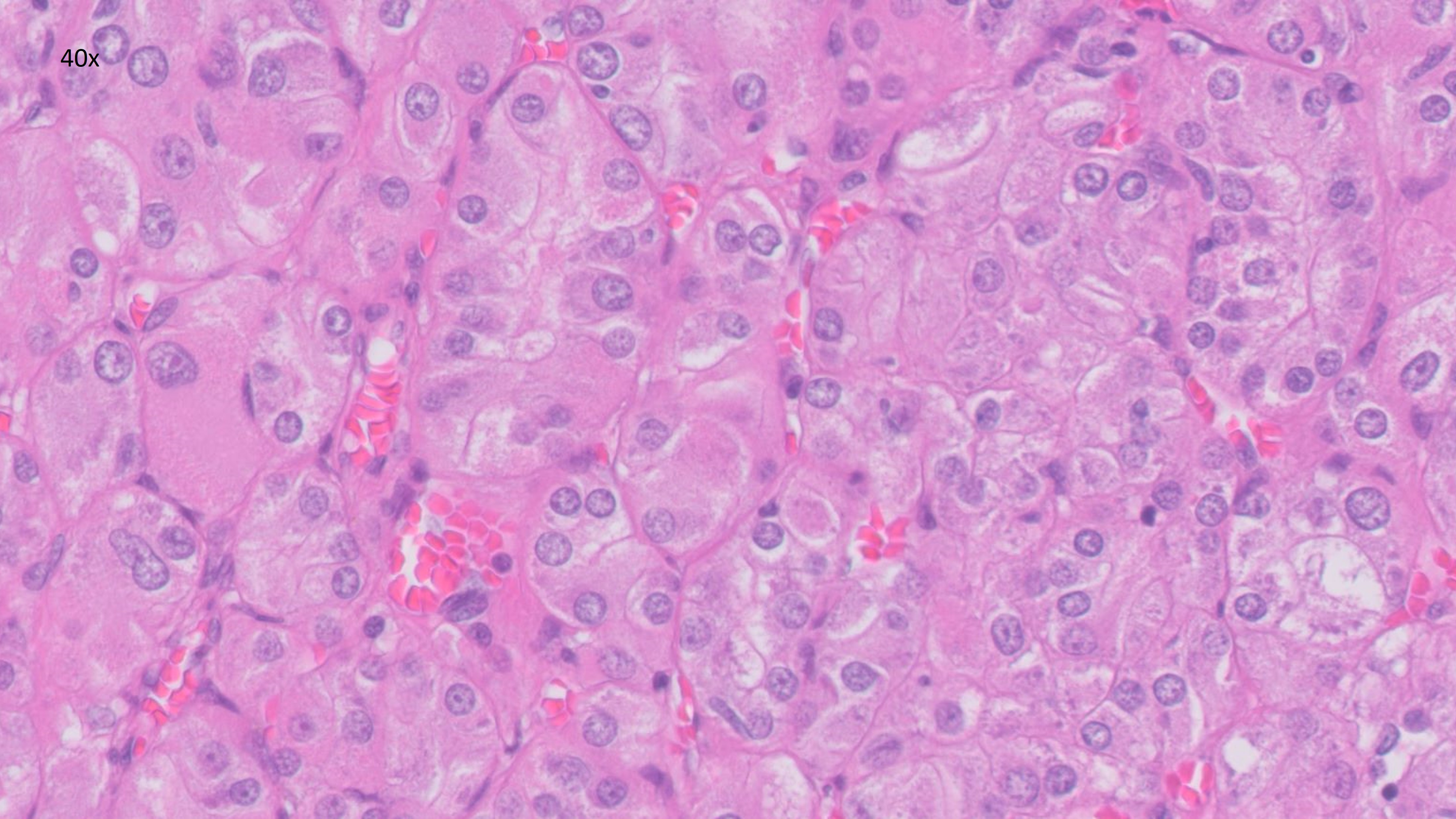 Microscopic image possibly detecting cancerous areas in human tissue